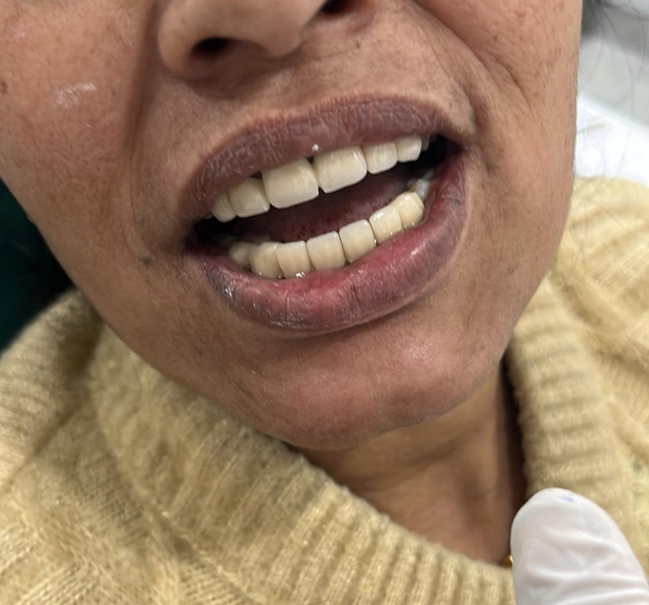 Full functional recovery post osseointegration & bone grafting