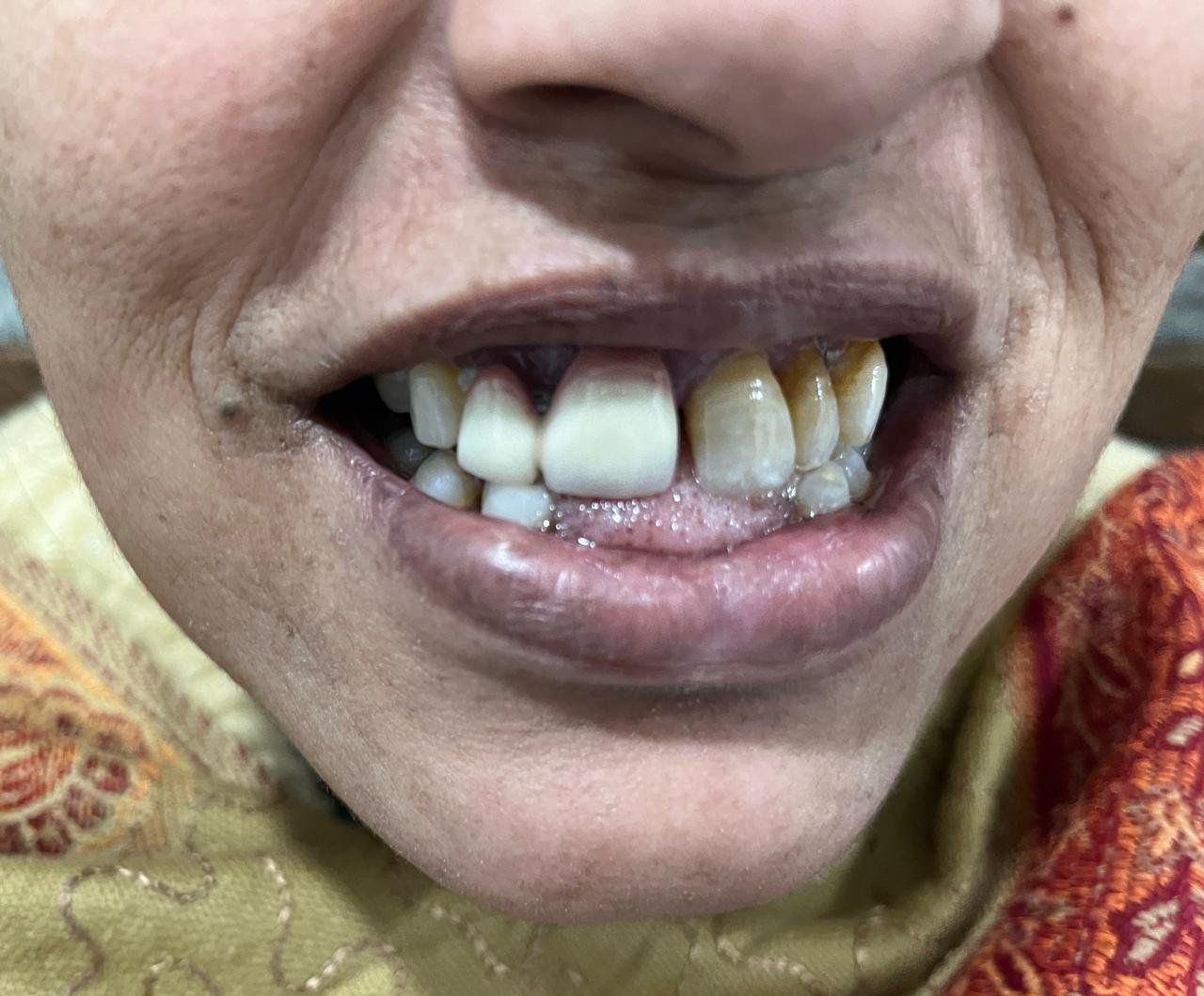 Complex ridge defect prior to bone grafting & oral reconstruction