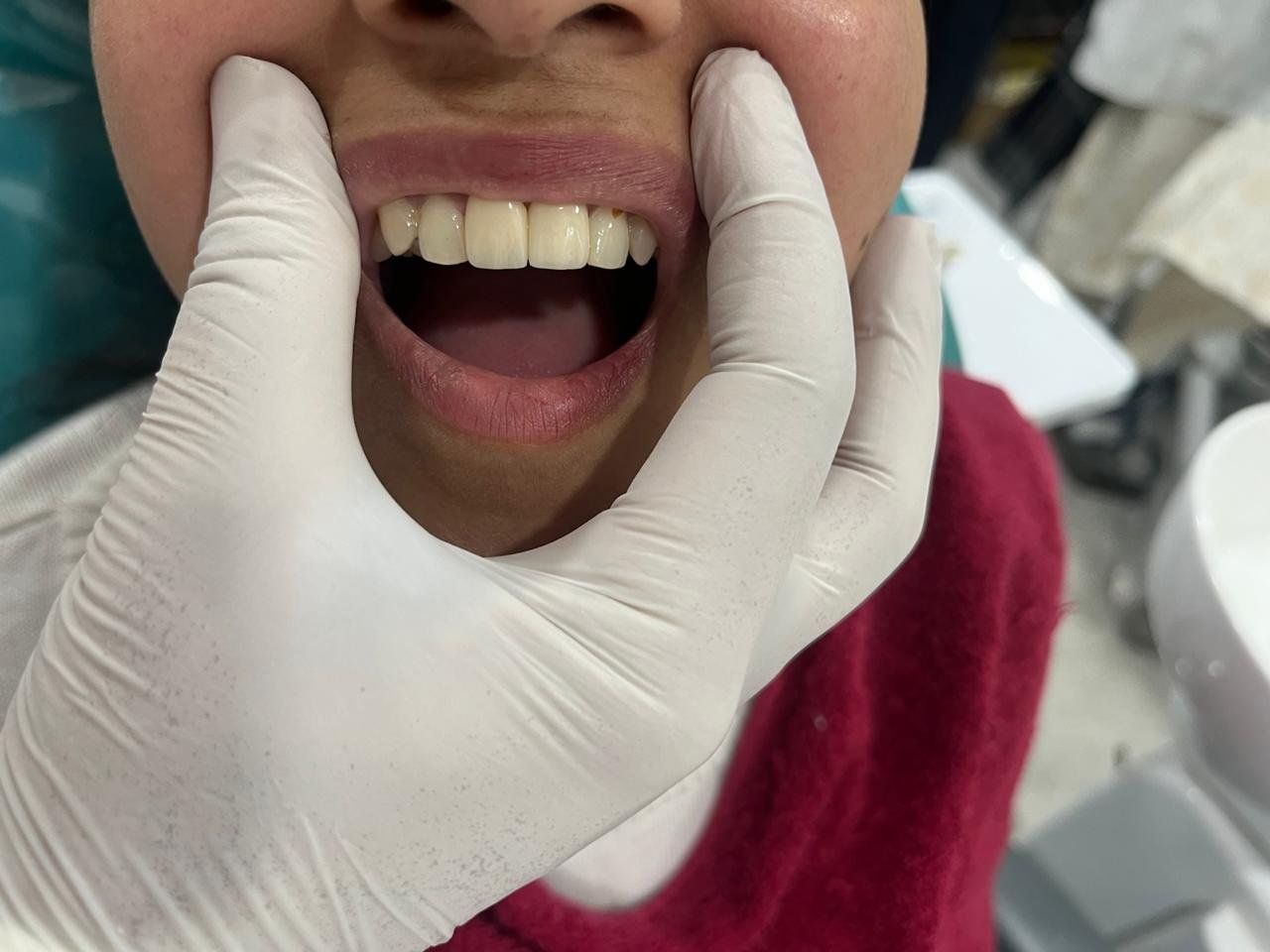 Successful dental implant placement & crown rehabilitation in Gorakhpur