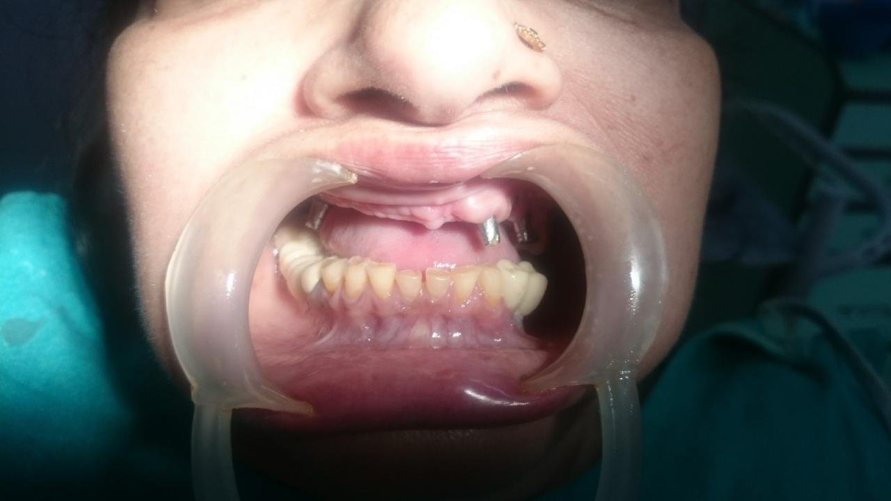 Pre-surgical dental implant evaluation & bone structure audit in Gorakhpur