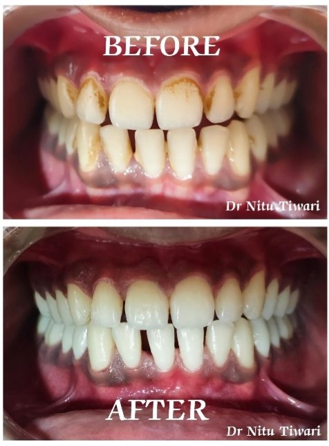 Cosmetic smile design & root canal therapy outcome by Dr. Nitu Tiwari