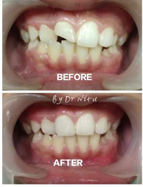 Pre & post tooth restoration & anterior alignment by Dr. Nitu Tiwari