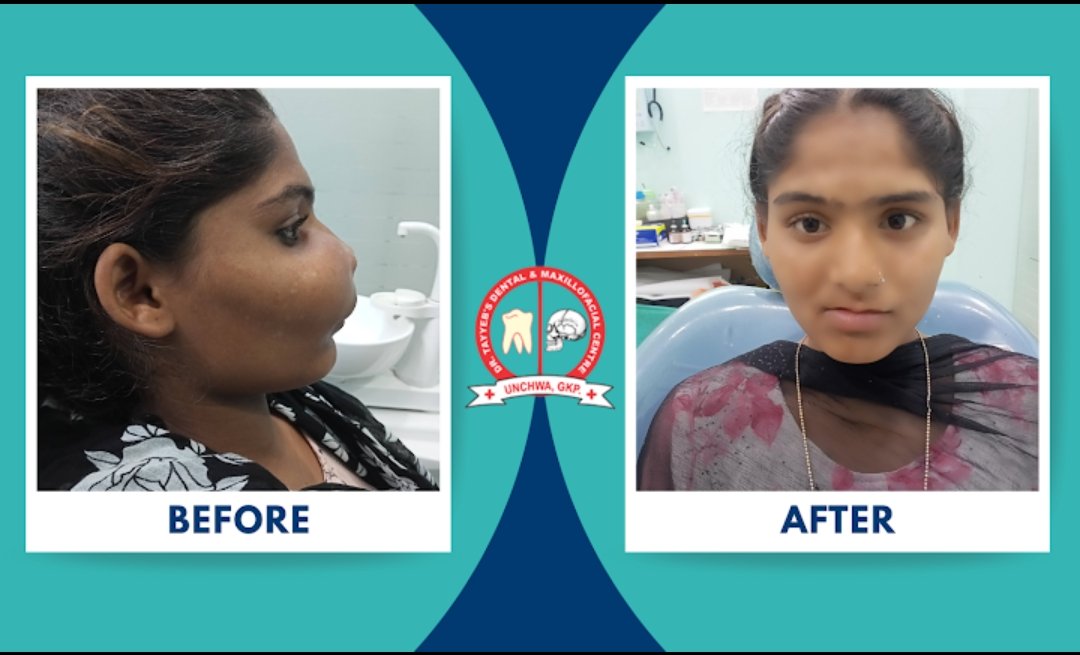 Complex maxillofacial reconstruction before & after clinical case